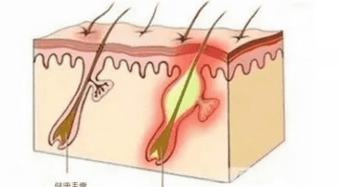 痘痘发炎红肿怎么办